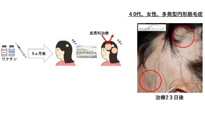 円形脱毛症　病院